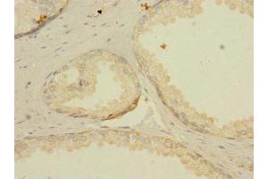 Immunohistochemistry of paraffin-embedded human prostate cancer using ABIN7158328 at dilution of 1:100 (LNX2 antibody  (AA 201-500))