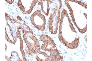 Formalin-fixed, paraffin-embedded human Prostate Carcinoma stained with EpCAM Rabbit Recombinant Monoclonal Antibody (EGP40/2571R). (Recombinant EpCAM antibody  (Extracellular Domain))