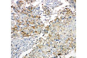 Anti-Connexin 43/GJA1 antibody, IHC(P): Human Lung Cancer Tissue (Connexin 43/GJA1 antibody  (C-Term))
