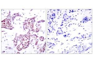 Immunohistochemical analysis of paraffin-embedded human breast carcinoma tissue using STAT6 (phospho- Tyr641) antibody (E011050). (STAT6 antibody  (pTyr641))
