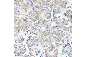 Immunohistochemistry of paraffin-embedded human liver cancer using EIF3L antibody (ABIN6131772, ABIN6140074, ABIN6140075 and ABIN6225315) at dilution of 1:100 (40x lens).