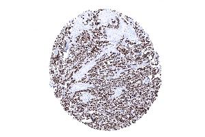 Invasive lobular breast cancer showing strong diffuse CKpan positivity in tumor cells (Recombinant pan Keratin antibody)