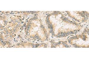 Immunohistochemistry of paraffin-embedded Human lung cancer tissue using NANP Polyclonal Antibody at dilution of 1:65(x200)