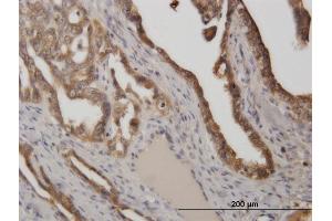 Immunoperoxidase of monoclonal antibody to STIP1 on formalin-fixed paraffin-embedded human ovarian cancer. (STIP1 antibody  (AA 1-543))