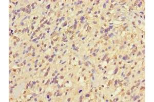 Immunohistochemistry of paraffin-embedded human glioma using ABIN7169120 at dilution of 1:100 (NIM1 antibody  (AA 1-436))