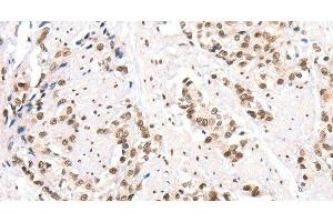 Immunohistochemistry of paraffin-embedded Human prostate cancer using CTBP2 Polyclonal Antibody at dilution of 1:40 (CTBP2 antibody)