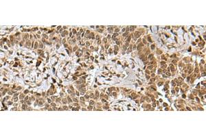 Immunohistochemistry of paraffin-embedded Human ovarian cancer tissue using BCL7B Polyclonal Antibody at dilution of 1:85(x200) (BCL7B antibody)