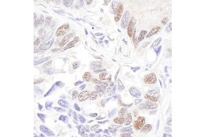 Immunohistochemistry (IHC) image for anti-Tumor Protein P53 (TP53) (AA 50-100) antibody (ABIN7448707)