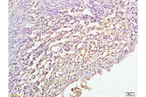 Formalin-fixed and paraffin embedded human cervical cancer labeled with Anti P45017A1 Polyclonal Antibody,Unconjugated  at 1:200 followed by conjugation to the secondary antibody and DAB staining. (CYP17A1 antibody  (AA 24-65))