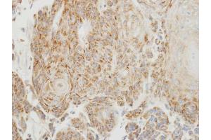 IHC-P Image Immunohistochemical analysis of paraffin-embedded human oral cancer, using PGP9. (UCHL1 antibody  (C-Term))