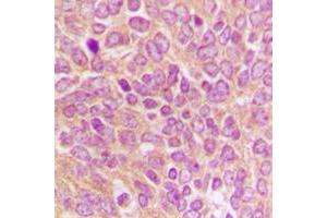 Immunohistochemical analysis of Caspase 9 p35 staining in human breast cancer formalin fixed paraffin embedded tissue section. (Caspase 9 p35 (C-Term) antibody)