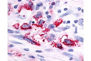 Anti-GPR116 antibody IHC of human Brain, Glioblastoma. (G Protein-Coupled Receptor 116 antibody  (Cytoplasmic Domain))