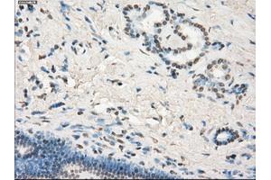 Immunohistochemical staining of paraffin-embedded Adenocarcinoma of colon tissue using anti-LTA4Hmouse monoclonal antibody. (LTA4H antibody)