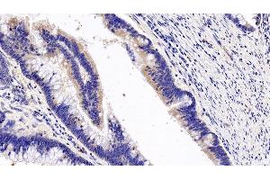 Detection of GCSFR in Human Colorectal cancer Tissue using Polyclonal Antibody to Colony Stimulating Factor Receptor, Granulocyte (GCSFR) (CSF3R antibody  (AA 271-428))