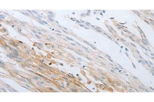 Immunohistochemistry of paraffin-embedded Human cervical cancer using LOX Polyclonal Antibody at dilution of 1:30 (LOX antibody)