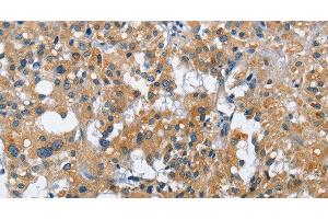 Immunohistochemistry of paraffin-embedded Human thyroid cancer tissue using CREB2 Polyclonal Antibody at dilution 1:40 (ATF4 antibody)