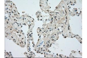 Immunohistochemical staining of paraffin-embedded Adenocarcinoma of breast tissue using anti-NAT8 mouse monoclonal antibody.