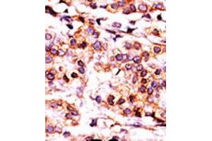 Formalin-fixed and paraffin-embedded human cancer tissue reacted with the primary antibody, which was peroxidase-conjugated to the secondary antibody, followed by AEC staining. (PANK1 antibody  (AA 332-360))