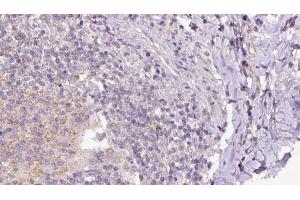 ABIN6273162 at 1/100 staining Human lymph cancer tissue by IHC-P. (SH2D1B antibody  (Internal Region))