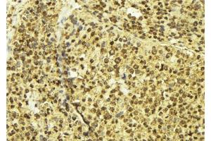ABIN6277602 at 1/100 staining Human breast cancer tissue by IHC-P.