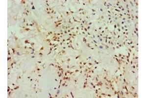 Immunohistochemistry of paraffin-embedded human breast cancer using ABIN7142904 at dilution of 1:100 (AKAP13 antibody  (AA 1-150))