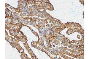Formalin-fixed, paraffin-embedded human Colorectal Carcinoma stained with EpCAM-Monospecific Mouse Monoclonal Antibody (EGP40/1372). (EpCAM antibody  (Extracellular Domain))