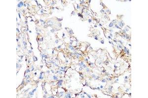 Immunohistochemistry of paraffin-embedded Human lung cancer using Fibronectin Polyclonal Antibody at dilution of 1:100 (40x lens). (Fibronectin antibody)