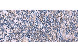 Immunohistochemistry of paraffin-embedded Human tonsil tissue using IL4R Polyclonal Antibody at dilution of 1:45(x200) (IL4 Receptor antibody)