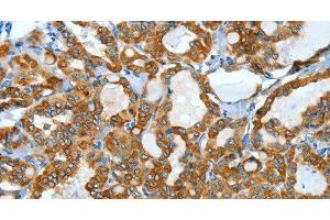 Immunohistochemistry of paraffin-embedded Human thyroid cancer using KRT40 Polyclonal Antibody at dilution of 1:50 (KRT40 antibody)