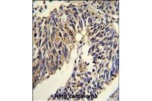 Formalin-fixed and paraffin-embedded human lung carcinoma reacted with TNFRSF14 Antibody (Center), which was peroxidase-conjugated to the secondary antibody, followed by DAB staining. (HVEM antibody  (AA 210-236))