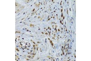 Immunohistochemistry of paraffin-embedded human gastric cancer using GABPB1 Antibody. (GABPB1 antibody  (AA 231-395))