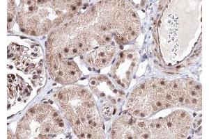 ABIN6267703 at 1/100 staining human kindey carcinoma tissue sections by IHC-P.