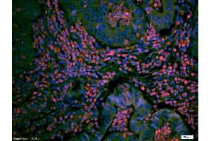 Formalin-fixed and paraffin embedded human breast cancer labeled with Anti TIEG1/KLF10 Polyclonal Antibody, Unconjugated (ABIN735173) at 1:200 followed by conjugation to the secondary antibody Goat Anti-Rabbit IgG, PE conjugated used at 1:200 dilution for 40 minutes at 37°C. (KLF10/TIEG1 antibody  (AA 423-480))