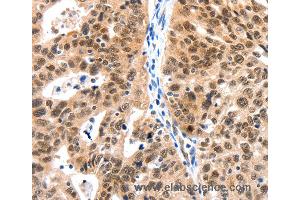 Immunohistochemistry of Human ovarian cancer using LRP5 Polyclonal Antibody at dilution of 1:115 (LRP5 antibody)