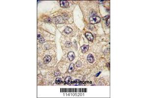 Formalin-fixed and paraffin-embedded human lung carcinoma tissue reacted with CD14 antibody (N-term), which was peroxidase-conjugated to the secondary antibody, followed by DAB staining. (CD14 antibody  (N-Term))