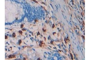Detection of TPS in Human Colorectal cancer Tissue using Monoclonal Antibody to Tryptase (TPS) (TPSAB1 antibody  (AA 161-262))