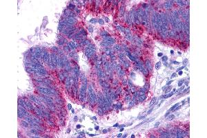 Anti-EDNRB / Endothelin B Receptor antibody IHC of human Colon, Carcinoma. (EDNRB antibody  (N-Term))
