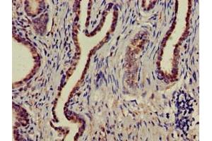 Immunohistochemistry of paraffin-embedded human prostate cancer using ABIN7160004 at dilution of 1:100 (MAPK6 antibody  (AA 383-712))