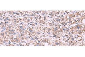 Immunohistochemistry of paraffin-embedded Human liver cancer tissue using GSTCD Polyclonal Antibody at dilution of 1:70(x200) (GSTCD antibody)