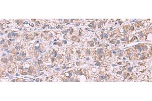 Immunohistochemistry of paraffin-embedded Human liver cancer tissue using GSTCD Polyclonal Antibody at dilution of 1:70(x200) (GSTCD antibody)
