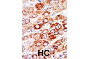 Formalin-fixed and paraffin-embedded human hepatocellular carcinoma tissue reacted with AK1 polyclonal antibody  , which was peroxidase-conjugated to the secondary antibody, followed by AEC staining. (Adenylate Kinase 1 antibody  (C-Term))