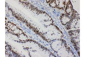 Anti-MCM2 antibody, IHC(P) IHC(P): Human Intestinal Cancer Tissue