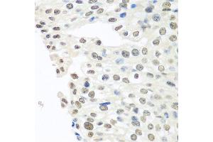 Immunohistochemistry of paraffin-embedded human prostate cancer using TARDBP antibody. (TARDBP antibody  (AA 1-100))
