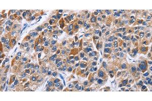 Immunohistochemistry of paraffin-embedded Human liver cancer tissue using ENPP5 Polyclonal Antibody at dilution 1:40 (ENPP5 antibody)