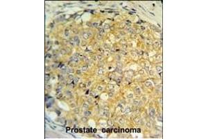 RNASEK Antibody (Center) (ABIN651452 and ABIN2840246) IHC analysis in formalin fixed and paraffin embedded human prostate carcinoma followed by peroxidase conjugation of the secondary antibody and DAB staining. (Ribonuclease K antibody  (AA 26-55))