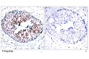 Immunohistochemical analysis of paraffin-embedded human breast carcinoma tissue using STAT5A (phospho S780) polyclonal antibody. (STAT5A antibody  (pSer780))