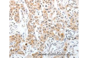 Immunohistochemistry of Human lung cancer using SLC22A3 Polyclonal Antibody at dilution of 1:40 (OCT4 antibody)