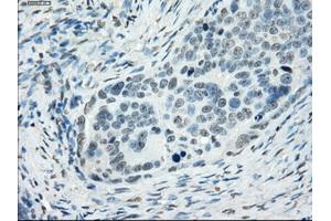 Immunohistochemical staining of paraffin-embedded colon tissue using anti-SSX2mouse monoclonal antibody. (SSX2 antibody)