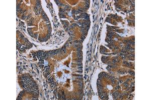 Immunohistochemistry of Human colon cancer using SLC1A6 Polyclonal Antibody at dilution of 1:40 (SLC1A6 antibody)