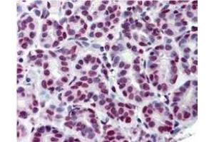 Immunohistochemistry using  Immunochemicals Anti-STAT5 pY694 monoclonal antibody shows detection of phosphorylated STAT5 pY694 in human breast tissue (40X). (STAT5A antibody  (pTyr694))